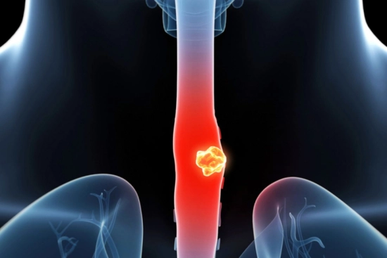 Causes of esophageal cancer 2024