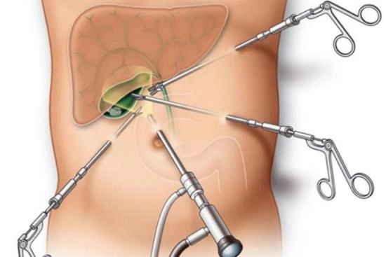 Colecistectomía: Tratamiento de la colecistitis en Turquía