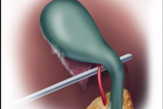 Causes of cholecystitis