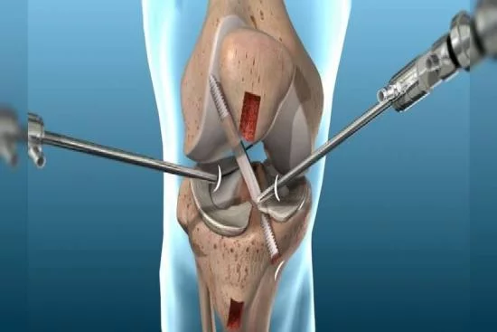 Chirurgie de genou 