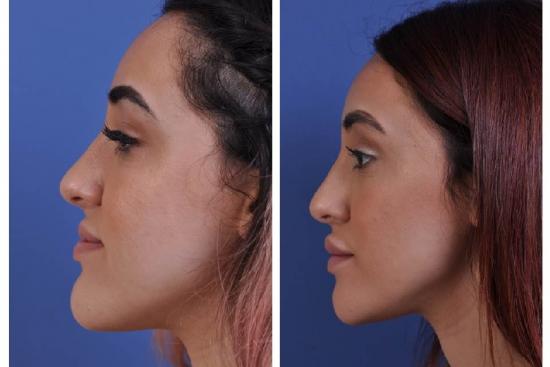 Jaw orthognathic Surgery In Turkey Affordable Costs