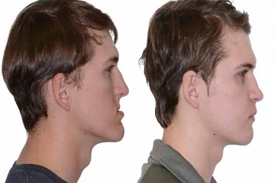  Photos: Before / After 0 in Turkey Orthognathic surgery, reduction, cost, jaw, surgery, turkey, clinic, recovery