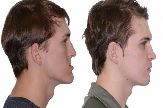 of our patients 0 Orthognathic surgery, cost, jaw surgery, turkey, recovery