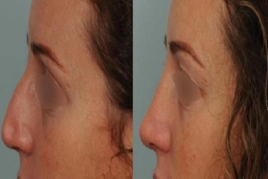 لمرضانا 1 طرف الأنف,عملية تصغير أرنبة الأنف,تصغير,أرنبة,رفع أرنبة الأنف بالخيوط,رفع,بالخيوط,رفع أرنبة الأنف بالفيلر,بالفيلر,تصغير أرنبة الأنف بالليزر,تكلفة,تركيا,إسطنبول