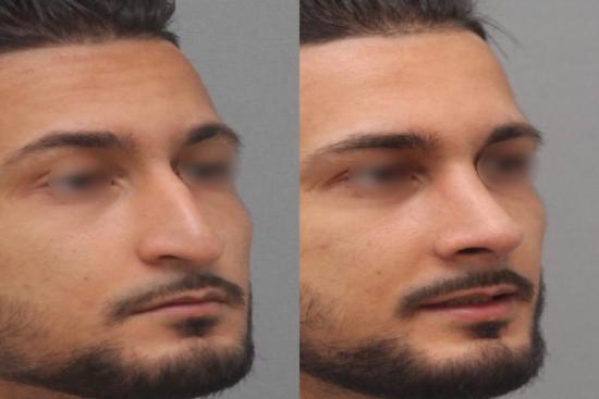3 Pinces à Modeler Le Nez En Silicone - Pour Redresser Et Affiner - Sans Chirurgie - Utilisation Quotidienne