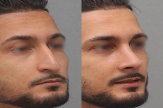 لمرضانا 2 طرف الأنف,عملية تصغير أرنبة الأنف,تصغير,أرنبة,رفع أرنبة الأنف بالخيوط,رفع,بالخيوط,رفع أرنبة الأنف بالفيلر,بالفيلر,تصغير أرنبة الأنف بالليزر,تكلفة,تركيا,إسطنبول