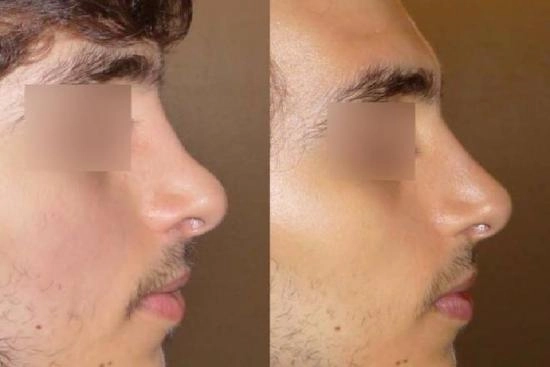 لمرضانا 3 طرف الأنف,عملية تصغير أرنبة الأنف,تصغير,أرنبة,رفع أرنبة الأنف بالخيوط,رفع,بالخيوط,رفع أرنبة الأنف بالفيلر,بالفيلر,تصغير أرنبة الأنف بالليزر,تكلفة,تركيا,إسطنبول