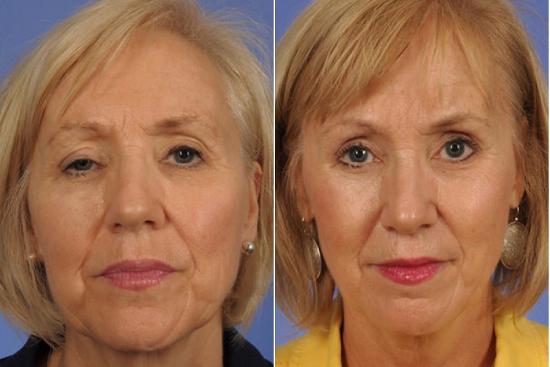  Photos: Before / After 0 in Turkey eye lift, turkey, correction, upper, cost, recovery, clinic, istanbul,doctor,ophthalmologist,surgeon, Antalya