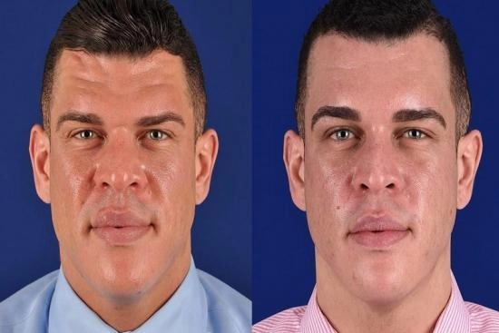 of our patients 0 Reduction, cost, female, forehead reduction surgery, Turkey, clinic, Istanbul