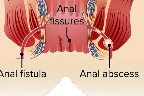 Treatment of perianal abscess in Turkey 2026