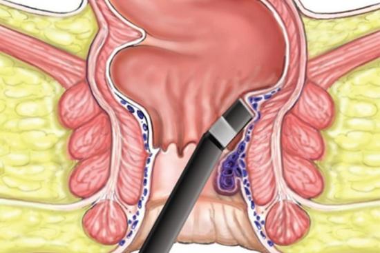 Наружный геморрой – способы быстрого и эффективного лечения