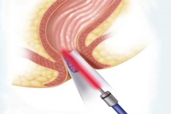 Chirurgie laser des hémorroïdes (Hémorroïdectomie) 