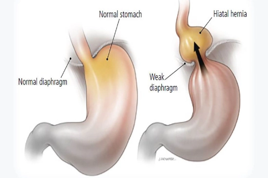 Diagnosis of hiatal hernia in Turkey