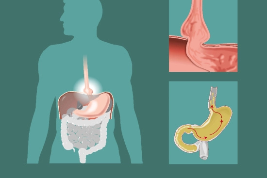 Causes of hiatus hernia