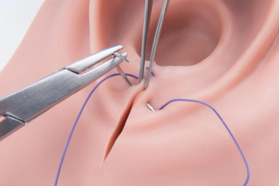 Laser hemorrhoid removal surgery in Turkey 2026