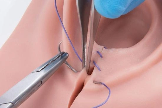 laser hemorrhoid surgery