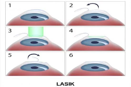 Лазерная хирургия глаза Ласик Турция 