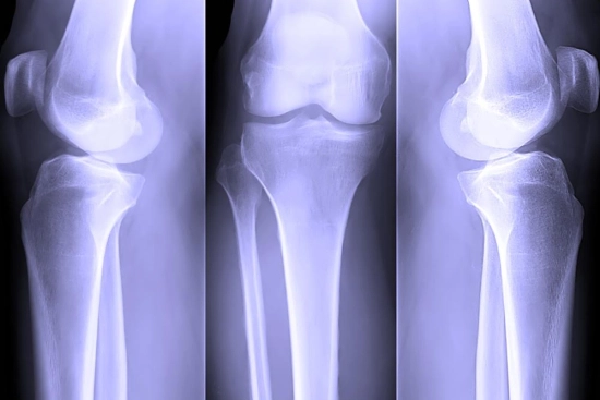 Meniscus tear surgery in Turkey