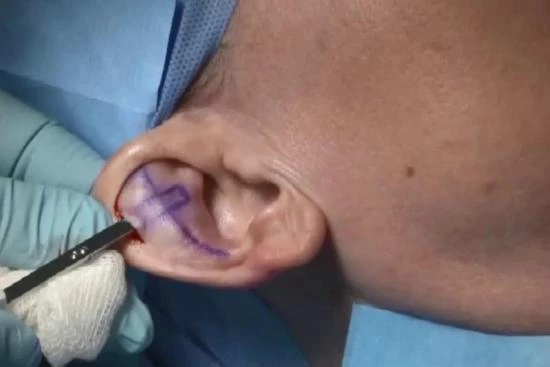 Chirurgie des oreilles décollées (Otoplastie) 