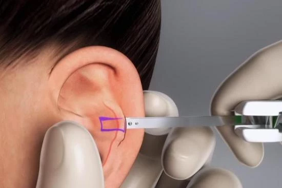 Chirurgie des oreilles décollées (Otoplastie) 