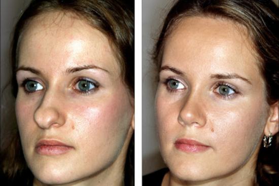  Photos: Before / After 0 in Turkey nose tip surgery,nasal tip surgery,nasal,bulbous nose tip surgery,bulbous,turkey,doctor,hospital,clinic,cost