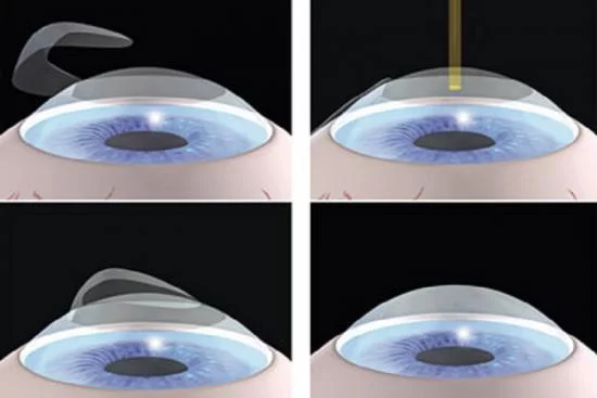 Рефракционная хирургия глаза Турция 