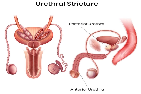 Diagnosis of urethral stricture in Turkey 2024