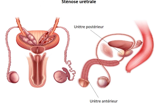 Diagnostic d'une sténose urétrale avant l'opération 2026