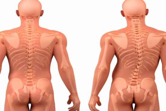 What causes scoliosis? 2026