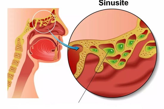 Diagnostic de la sinusite en Turquie 2025