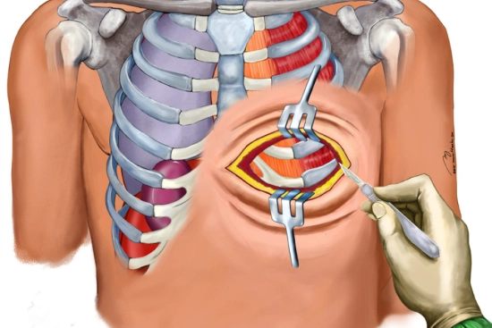 thoracic surgery in Turkey