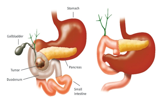 Whipple procedure process in Turkey