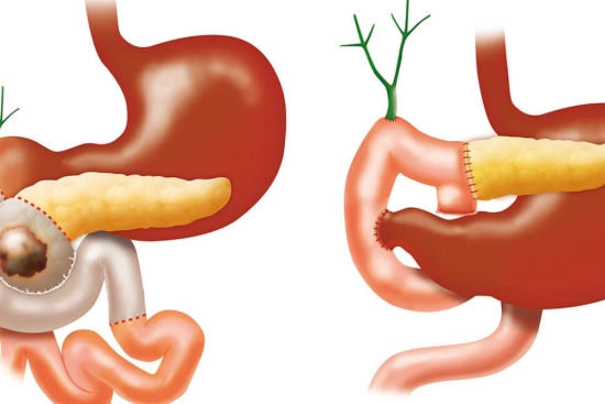 لماذا تُجرى جراحة ويبل؟ 2026