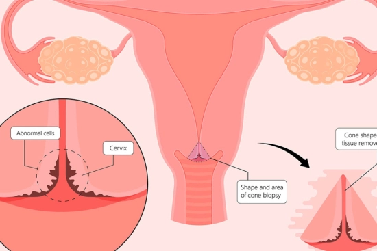 When is cervical conization recommended? 2026