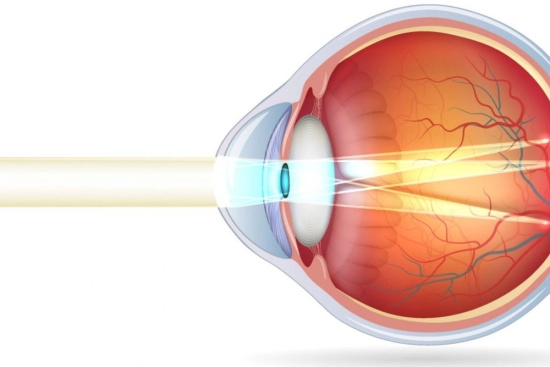 Myopic astigmatism