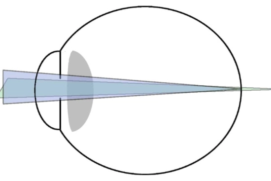 Correction of astigmatism in Turkey