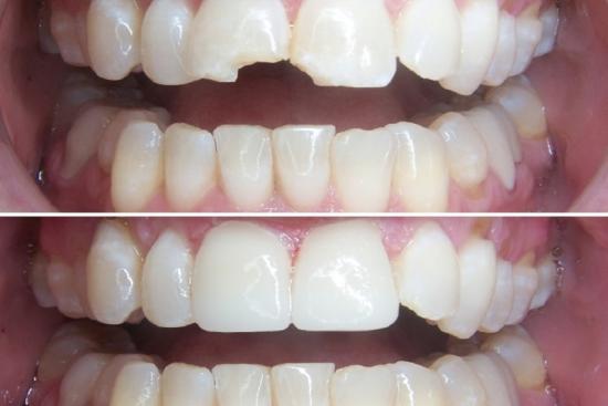  Photos: Before / After 0 in Turkey dental crowns, Cost, teeth crowns, turkey