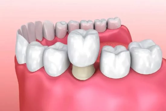 Dental crowns indications 2024
