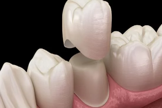 What are the best types of tooth crowns? 2024