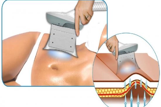 Cryolipolysis Turkey 