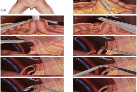 Cystectomy Turkey 