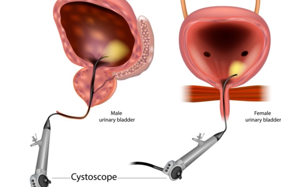 Cystoscopy: The reference examination for bladder exploration 2024