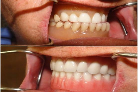 Photos Avant / Après 0 prothèses dentaires, dentier, complet, partiel, Turquie, prix