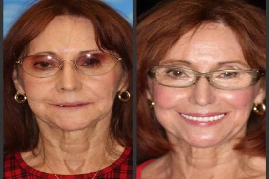 of our patients 1 denture, Turkey, prices, removable dental prosthesis