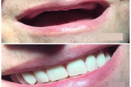 of our patients 3 denture, Turkey, prices, removable dental prosthesis