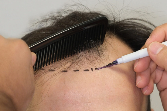 Trasplante de pelo sintético
