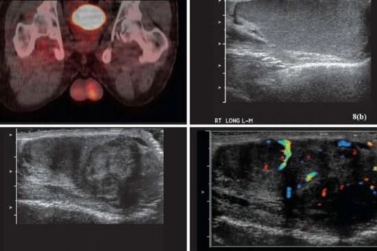 Testicular ultrasound