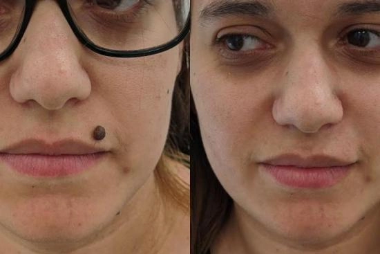 of our patients 0 mole removal, laser, scalpel, Turkey, costs