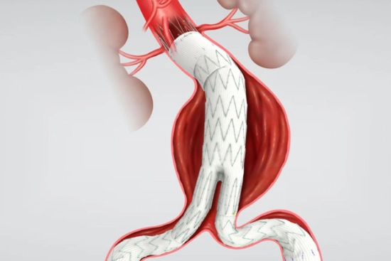 التحول الجذري في علاج الأبهر: كيف تجنب الجراحة الكبرى؟ 2026