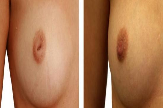  Photos: Before / After 0 in Turkey nipple cosmetic surgery, nipple reduction in turkey, reduction, inverted nipple surgery in turkey, inverted, clinic, hospital, doctor, aesthetic surgeon,plastic surgeon,cosmetic surgeon,price